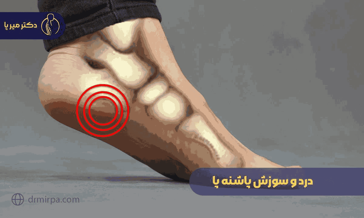 درمان سریع و مؤثر درد و سوزش پاشنه پا با روشهای ساده