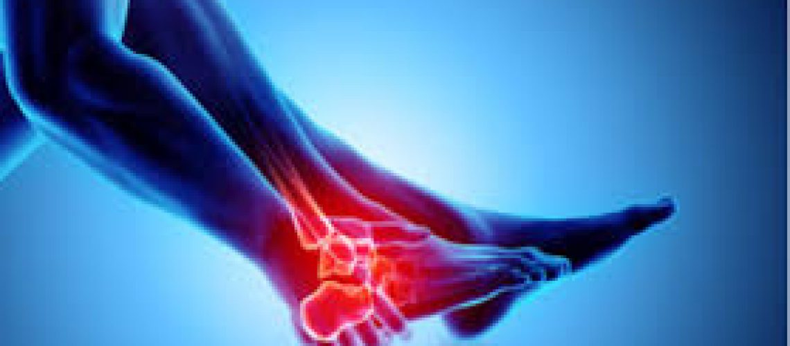 آرتروز پا و درمان آن